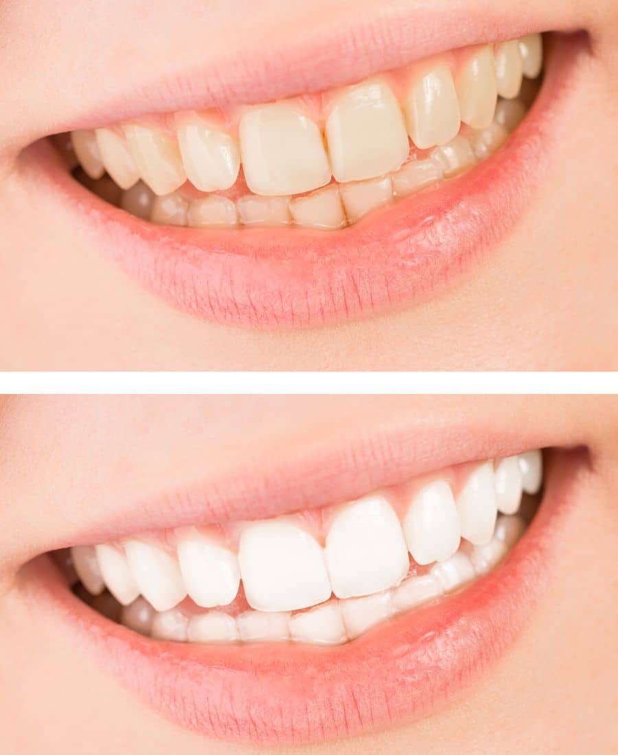 Before and after photos for teeth whitening