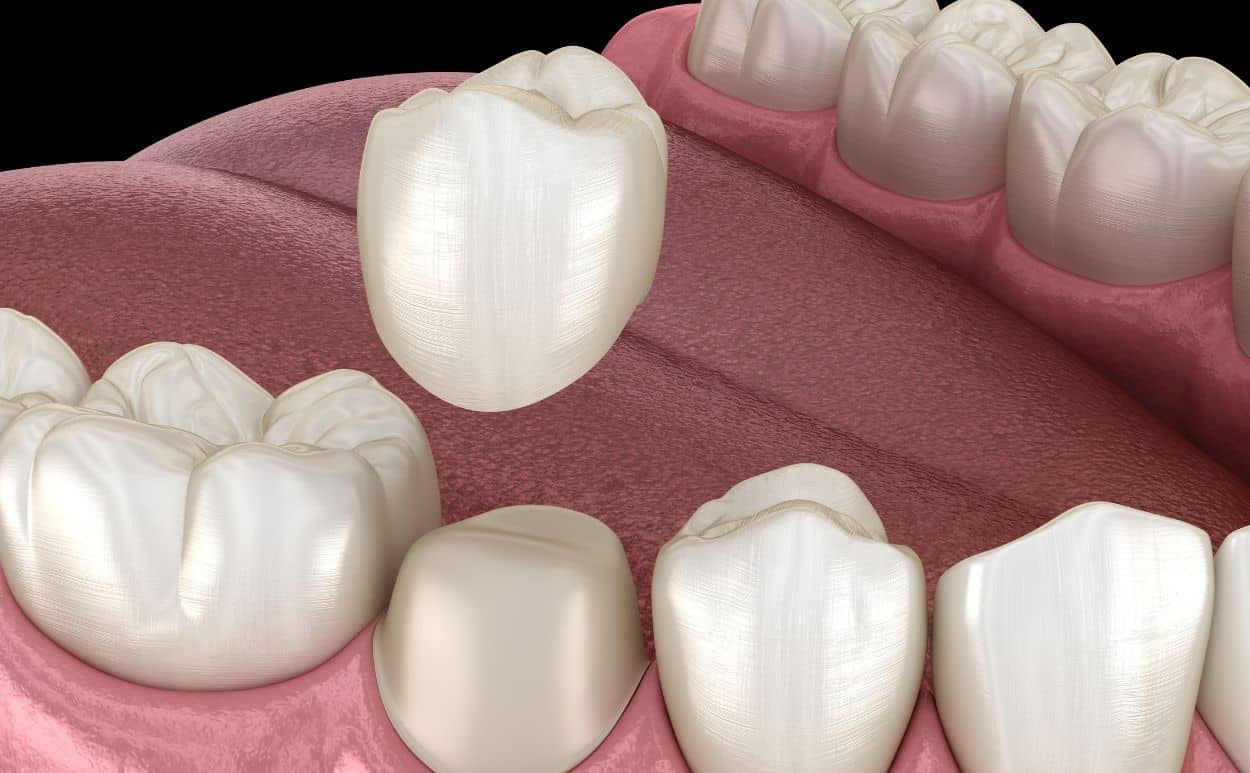 Image showing how a crown fits over a tooth